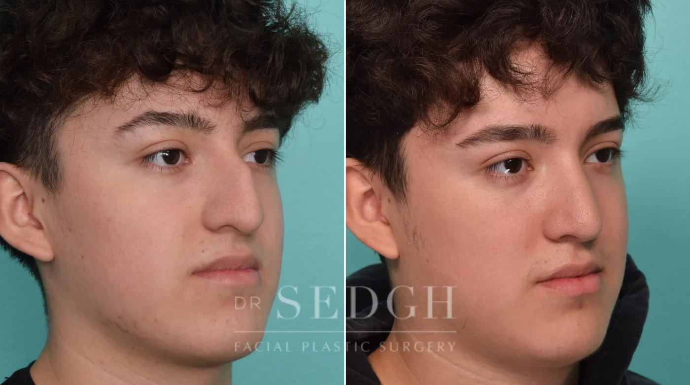 Patient 296 before Rhinoplasty, view 1