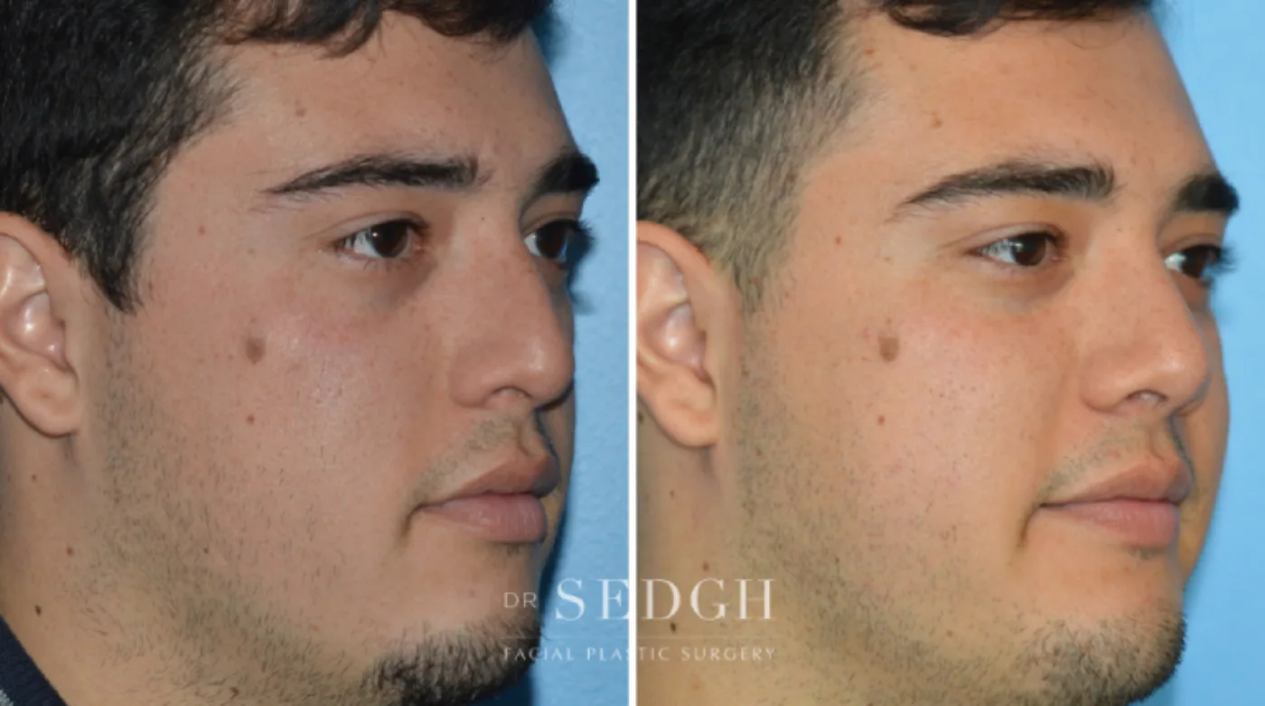 Patient 7 before Crooked Nose Surgery, view 2