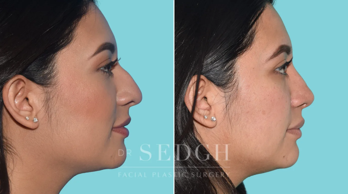 Patient 34 after Rhinoplasty, view 2
