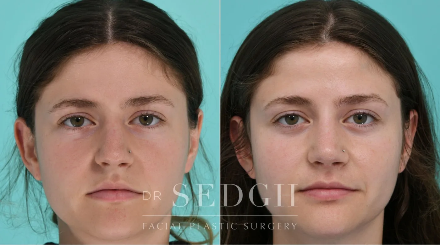 Patient 338 after Female Rhinoplasty, view 2