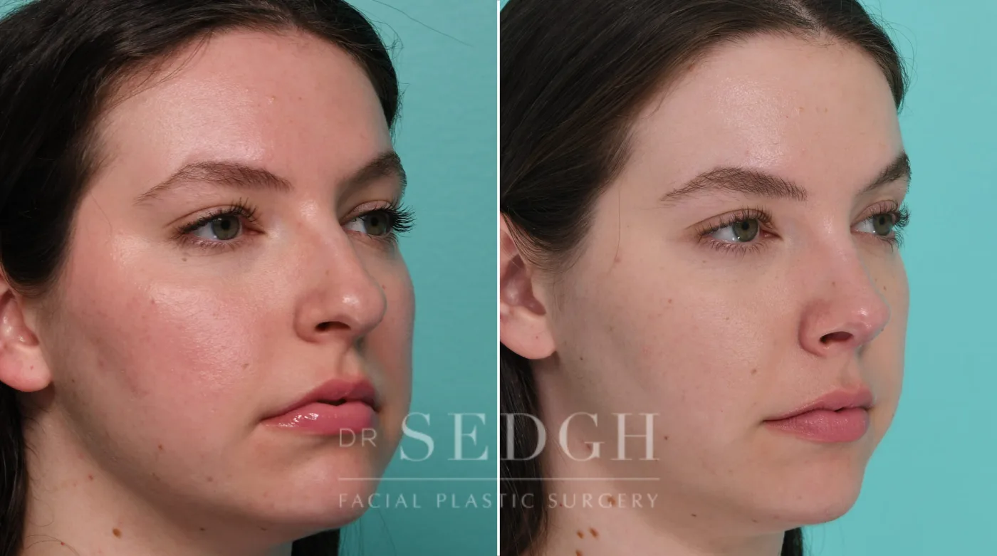 Patient 326 before Rhinoplasty, view 2