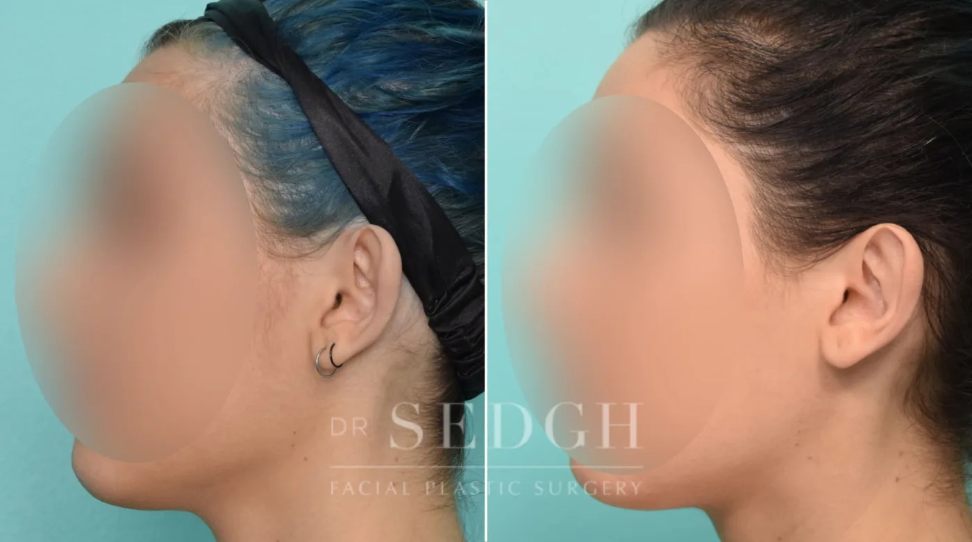 Patient 267 after Ear Pinning Surgery, view 1