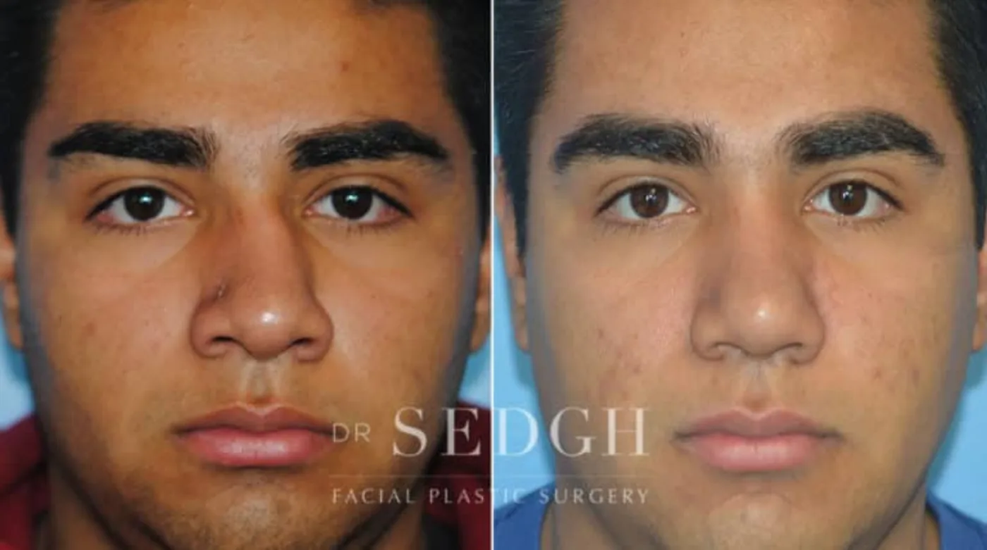 Patient 4 before Hispanic Rhinoplasty, view 1