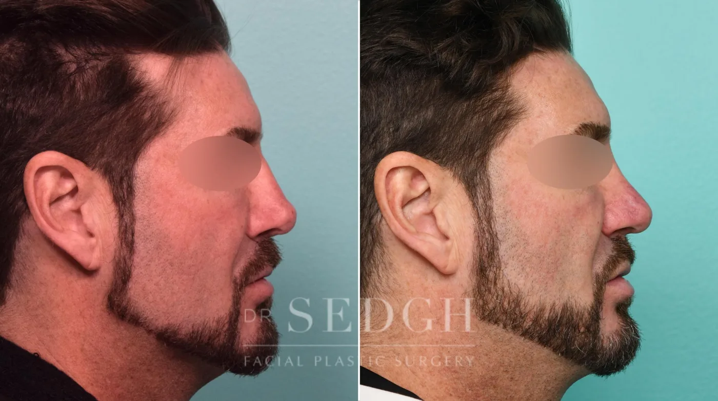 Patient 309 after Neck Liposuction, view 1