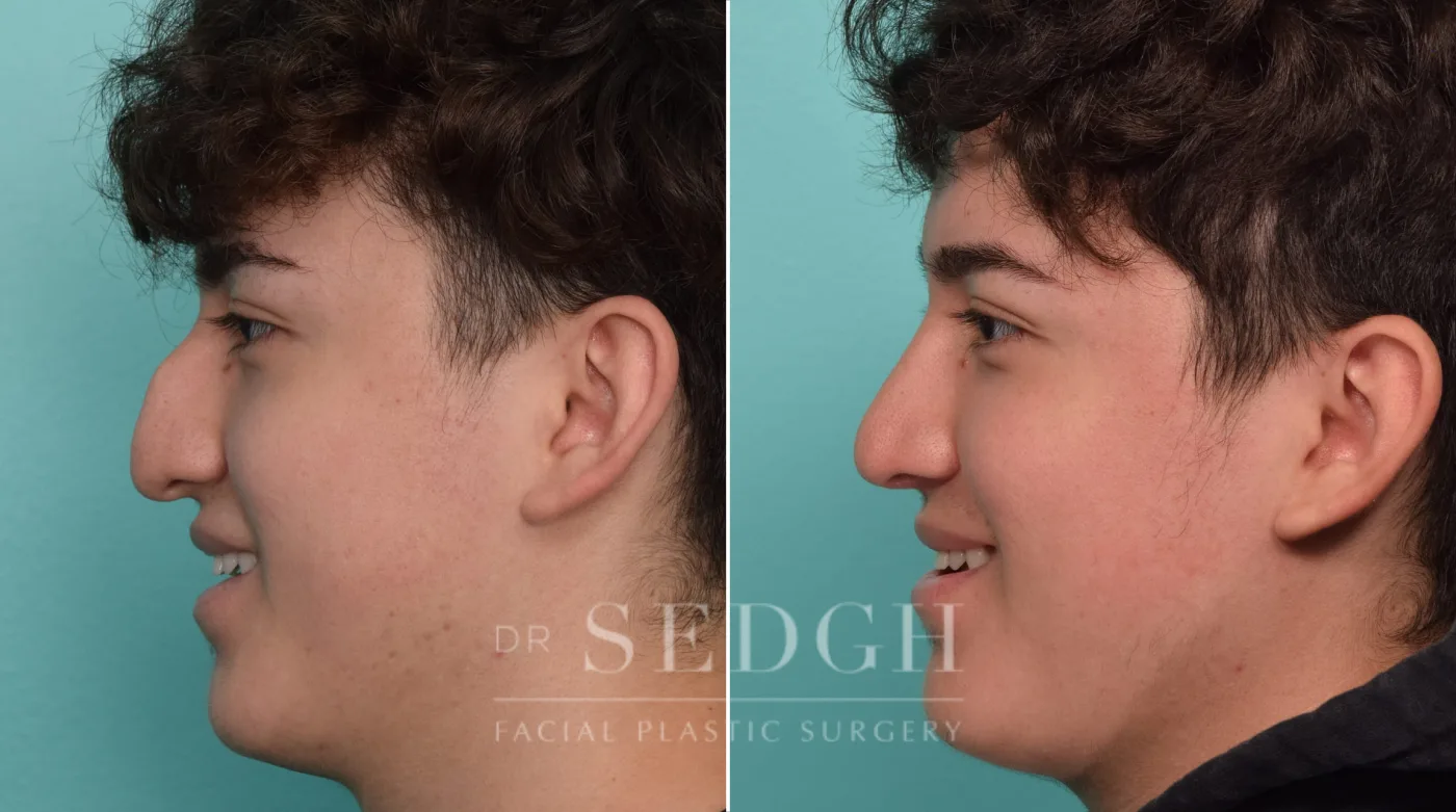 Patient 296 after Rhinoplasty, view 2