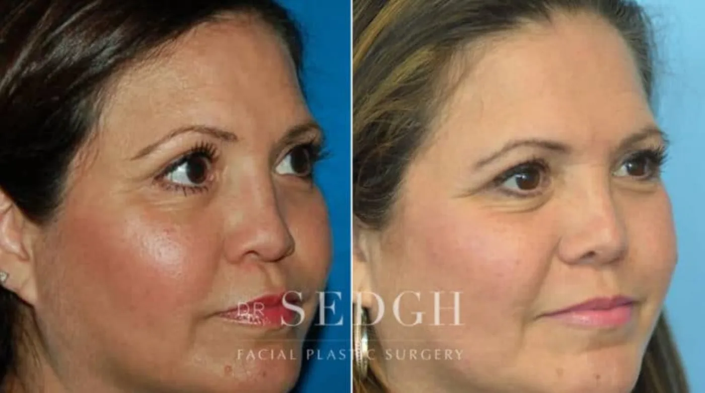 Patient 3 after Crooked Nose Surgery, view 1