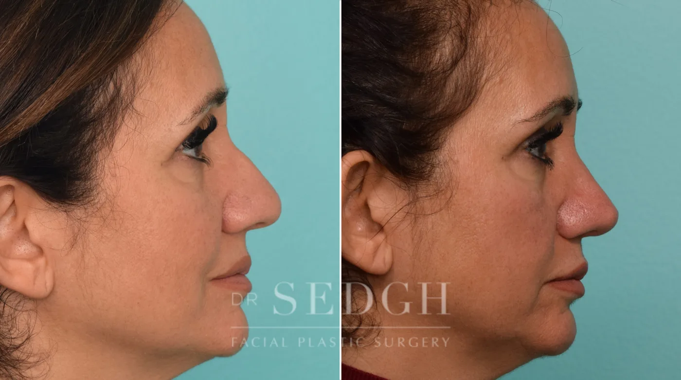 Patient 275 after Middle Eastern Rhinoplasty, view 1