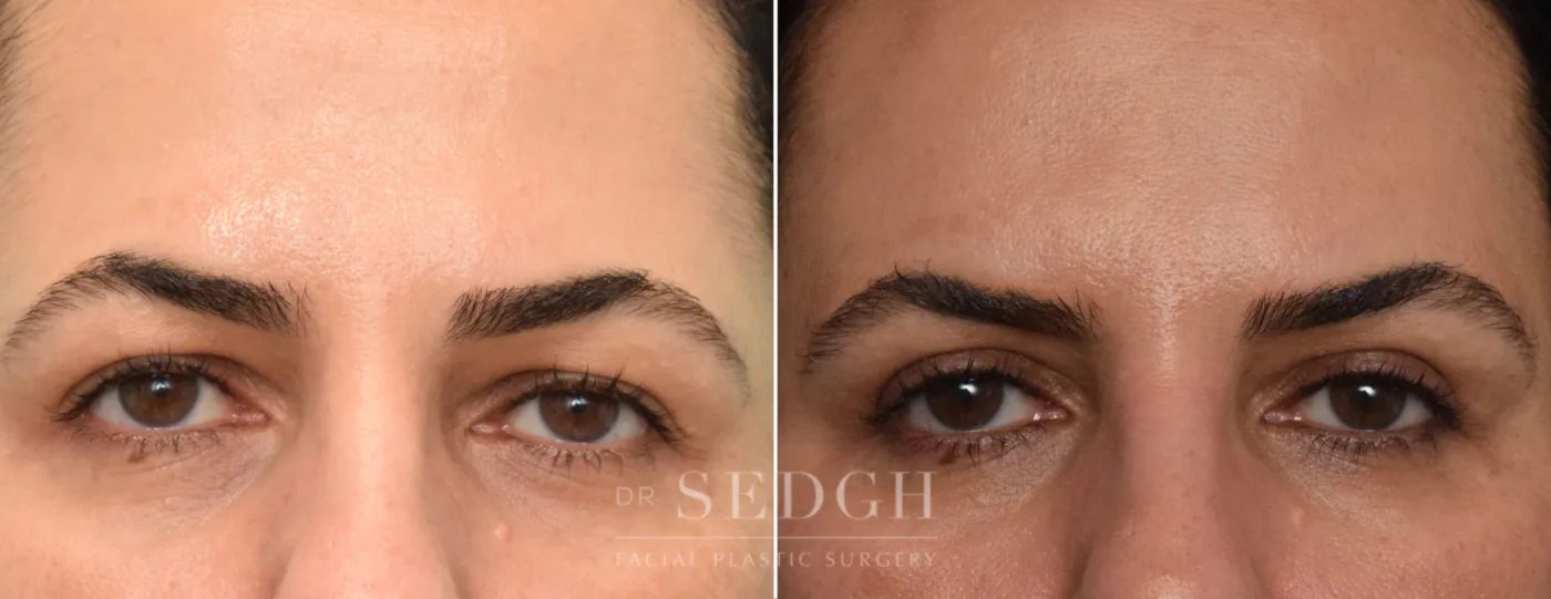 Patient 252 after Upper Blepharoplasty, view 1