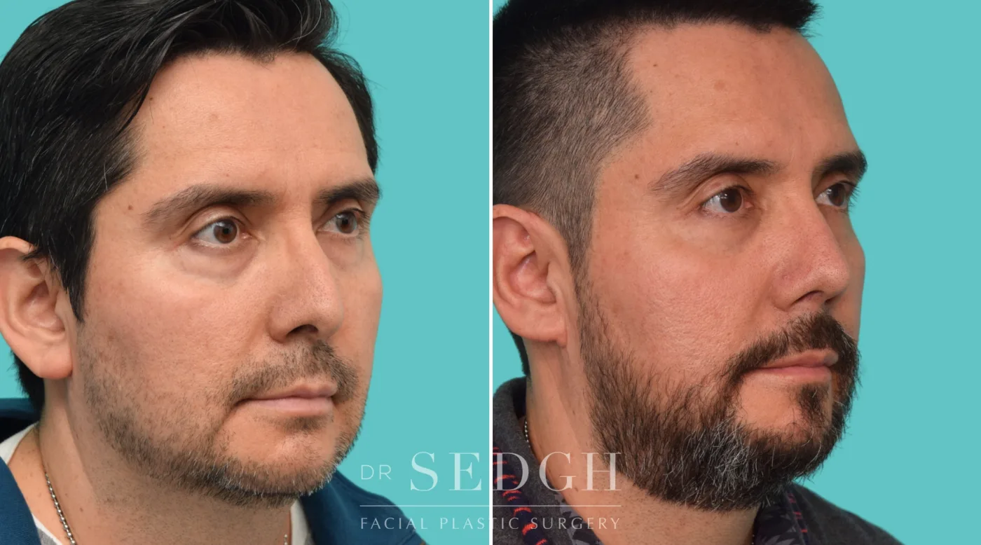 Patient 355 after Hispanic Rhinoplasty, view 2