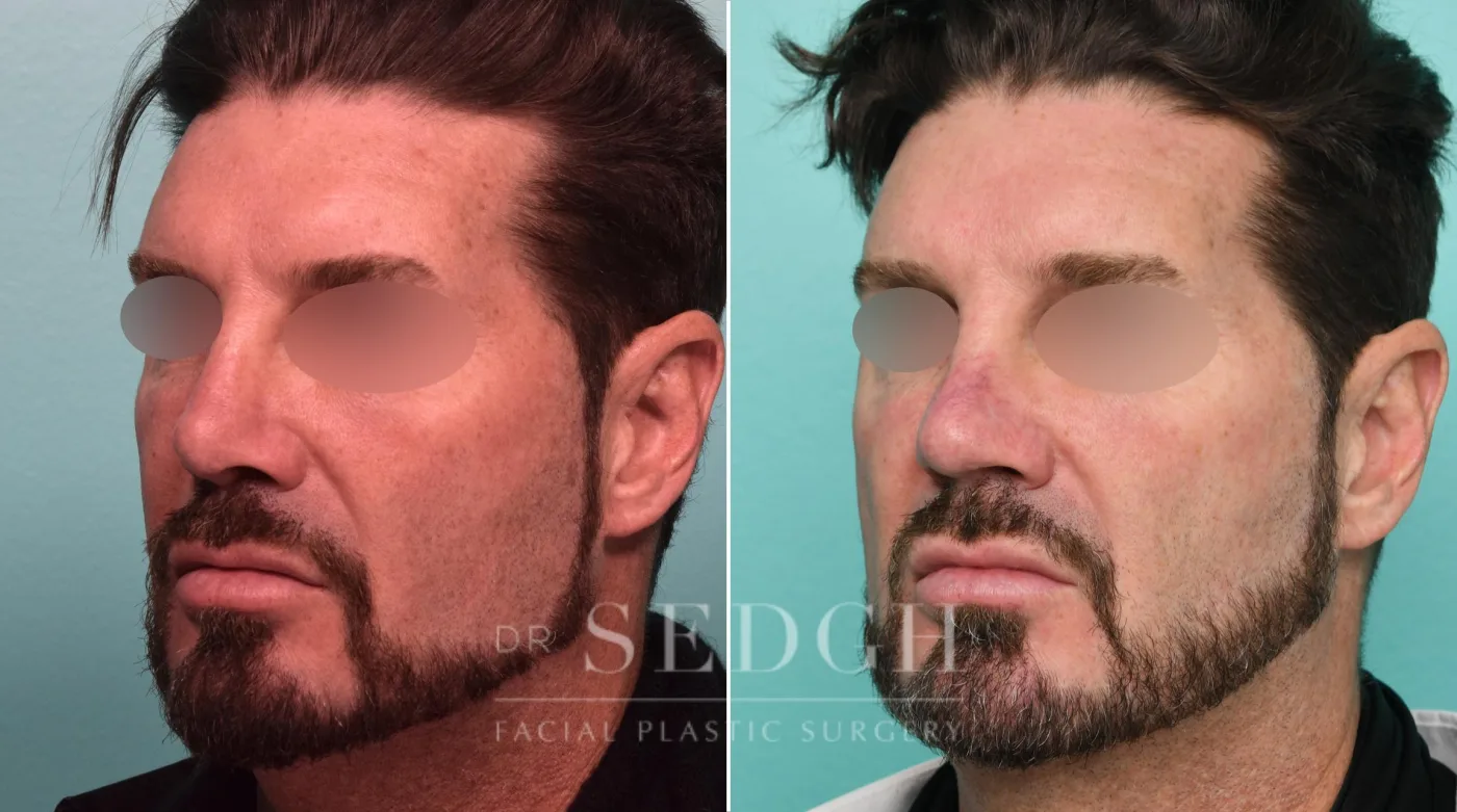 Patient 309 before Neck Liposuction, view 2