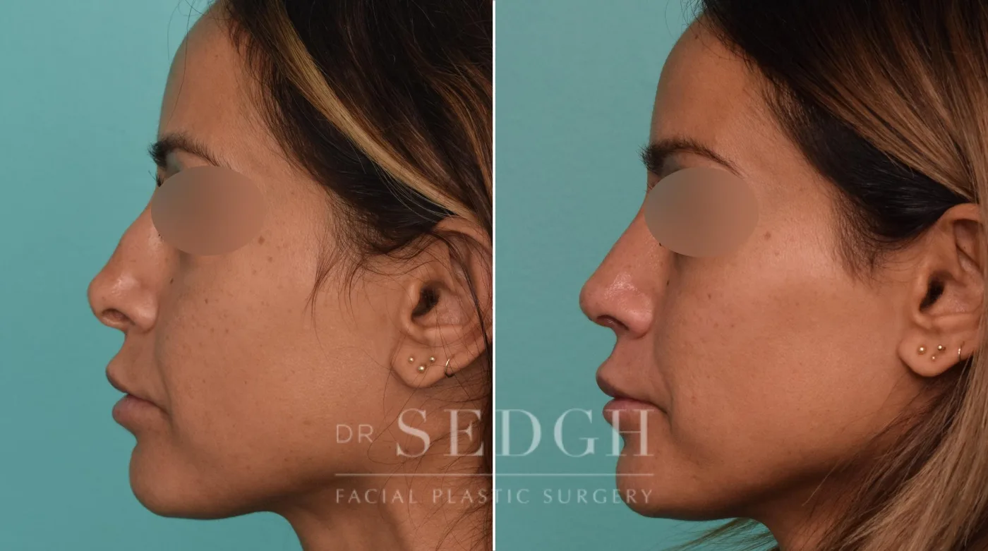 Patient 259 after Revision Rhinoplasty, view 2