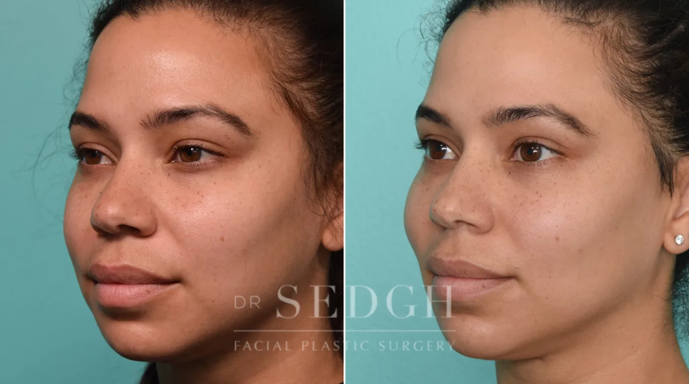 Patient 261 before Neck Liposuction, view 2