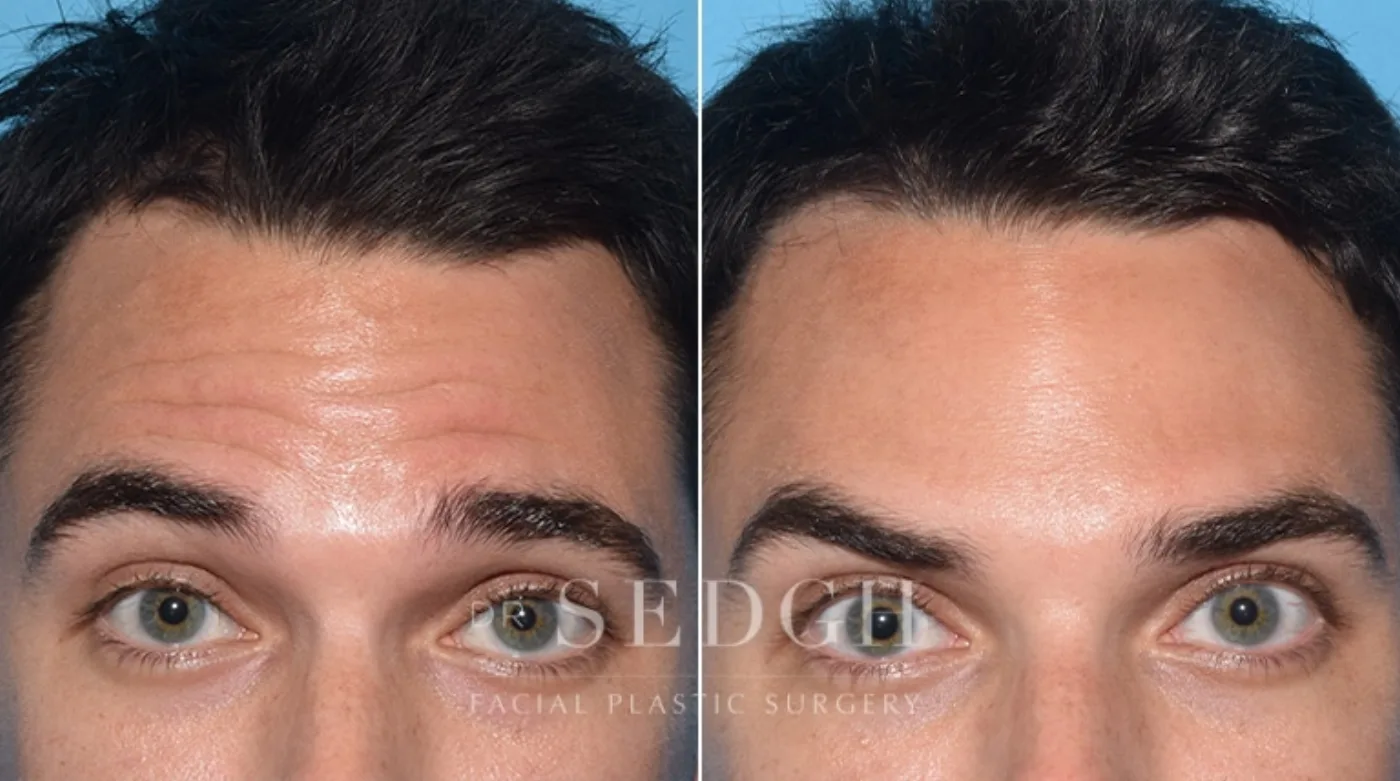 Patient 4 before Wrinkle Relaxers, view 1