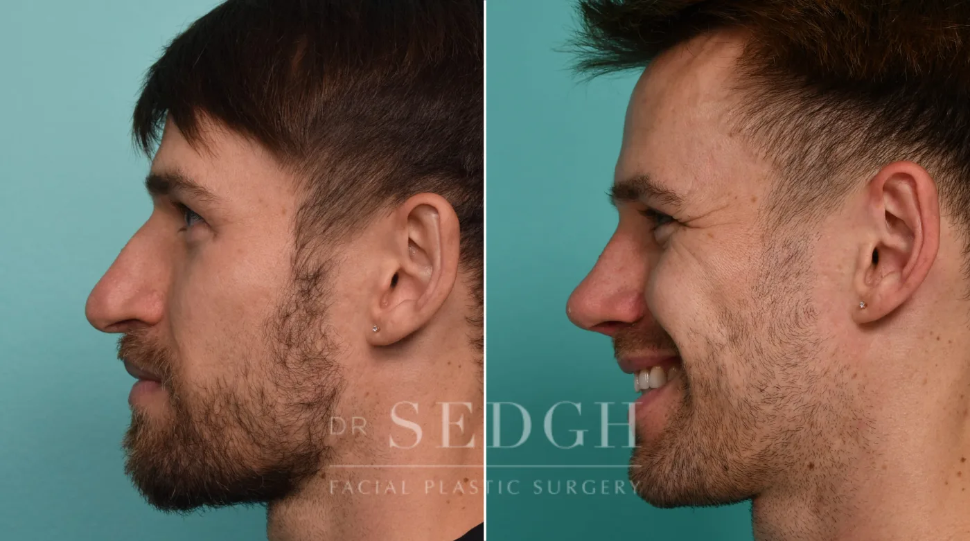 Patient 330 after Revision Rhinoplasty, view 2