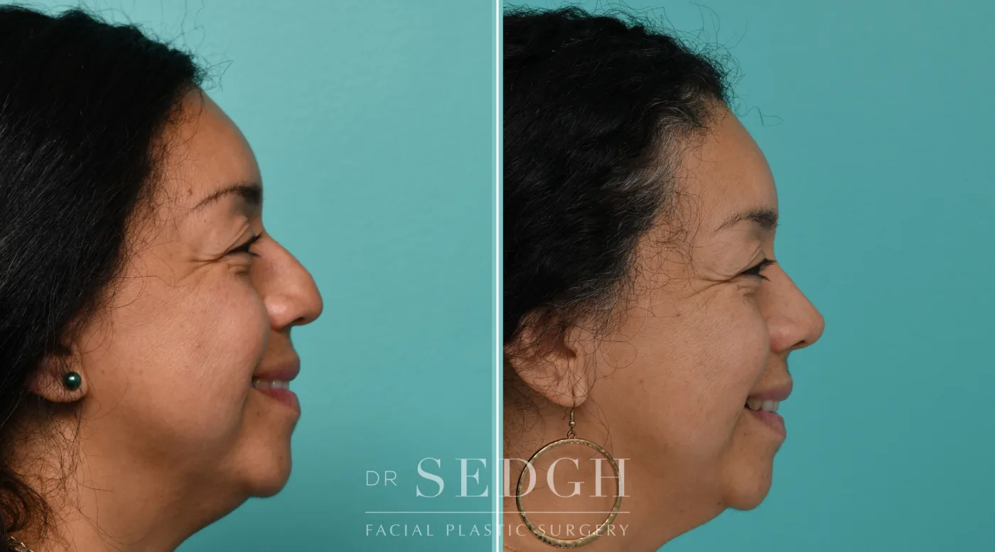 Patient 341 before Hispanic Rhinoplasty, view 1