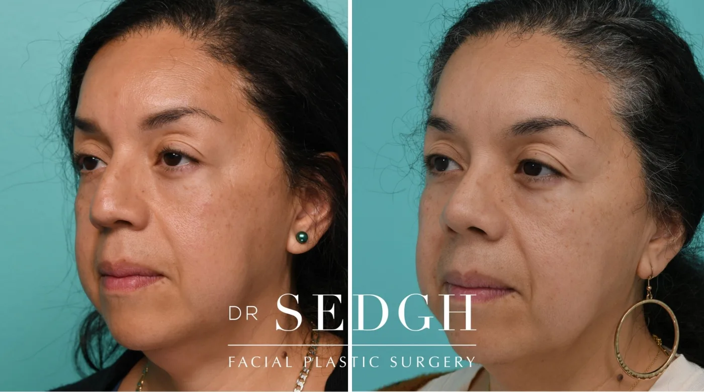 Patient 334 after Female Rhinoplasty, view 2