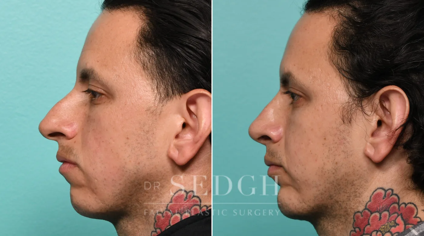 Patient 323 after Chin Augmentation, view 2
