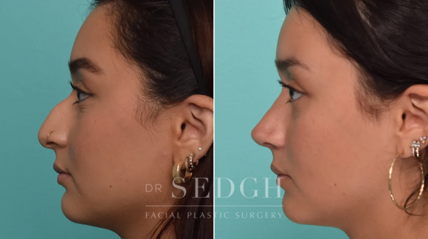 Patient 287 after Female Rhinoplasty, view 1