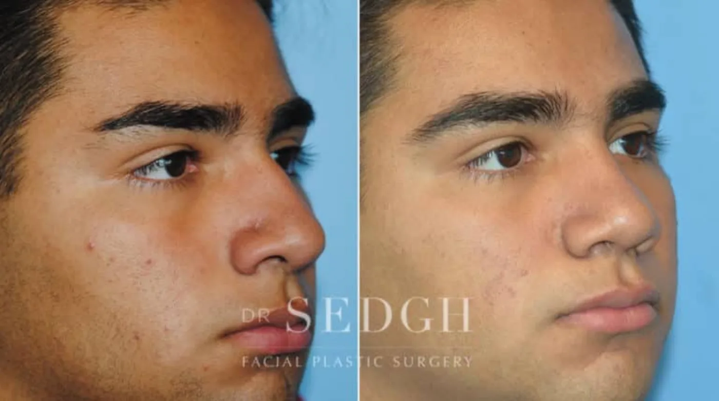 Patient 4 after Hispanic Rhinoplasty, view 1