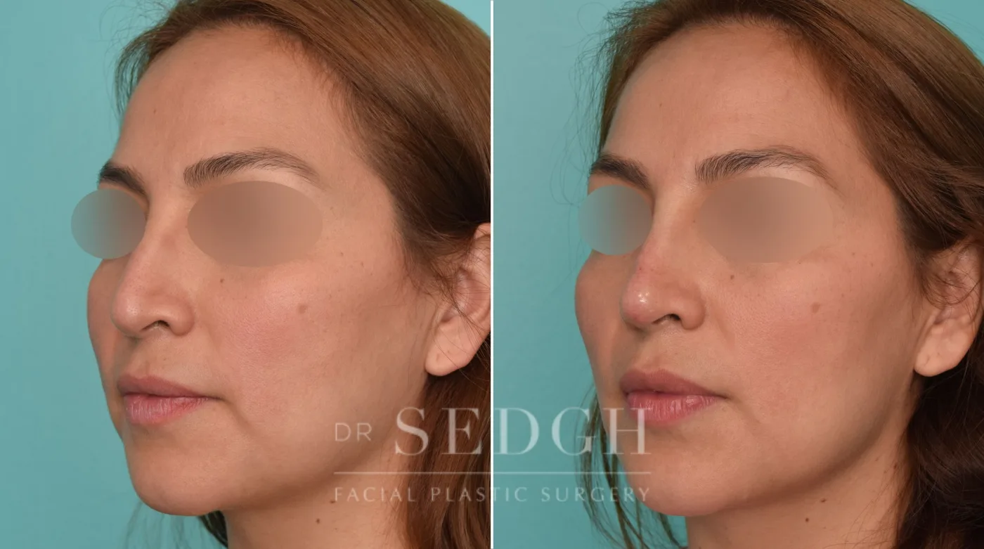 Patient 218 before Liquid Rhinoplasty, view 1