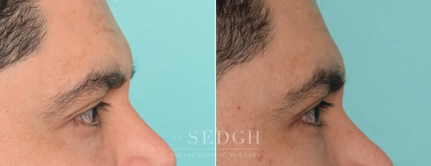 Patient 302 after Lower Blepharoplasty, view 1