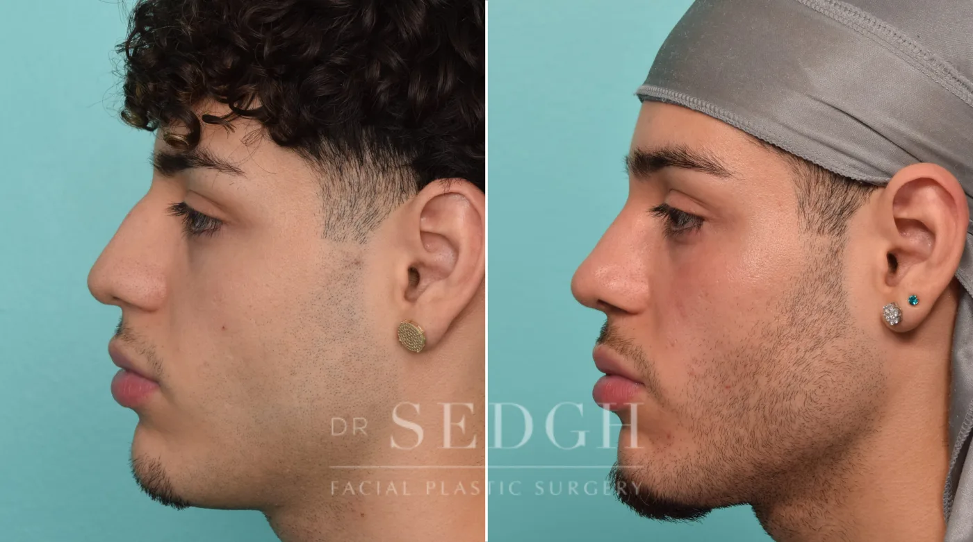 Patient 289 after Rhinoplasty, view 1
