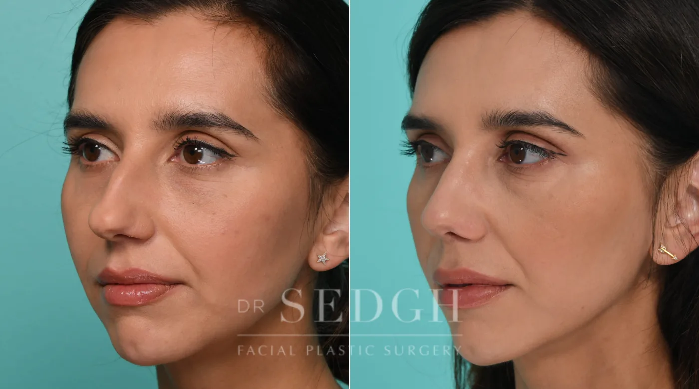 Patient 325 before Female Rhinoplasty, view 2