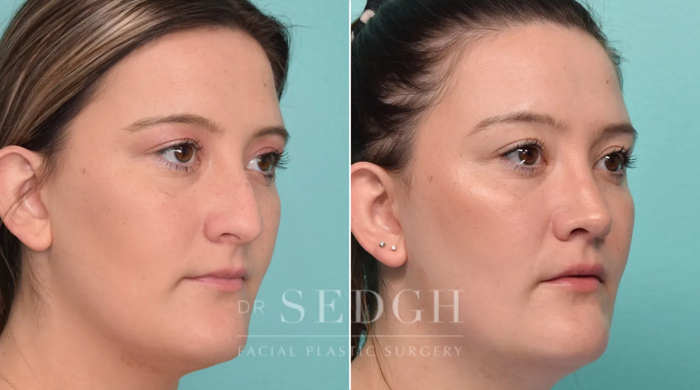 Patient 303 before Rhinoplasty, view 1