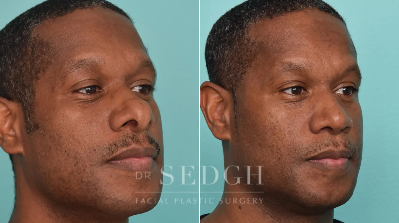 Patient 272 before African American Rhinoplasty, view 2