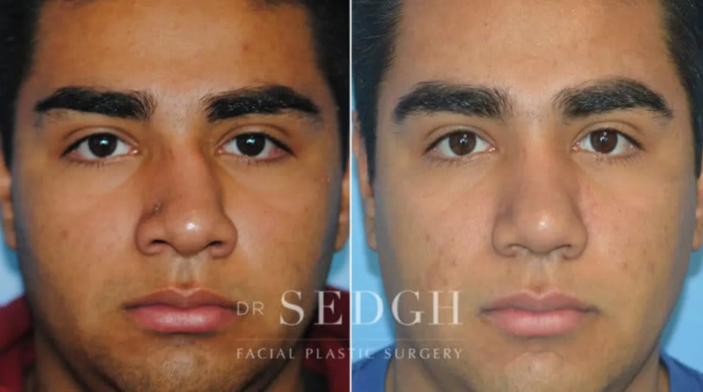Patient 4 before Crooked Nose Surgery, view 1