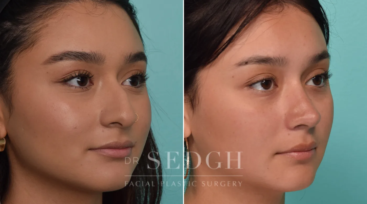 Patient 287 before Female Rhinoplasty, view 2
