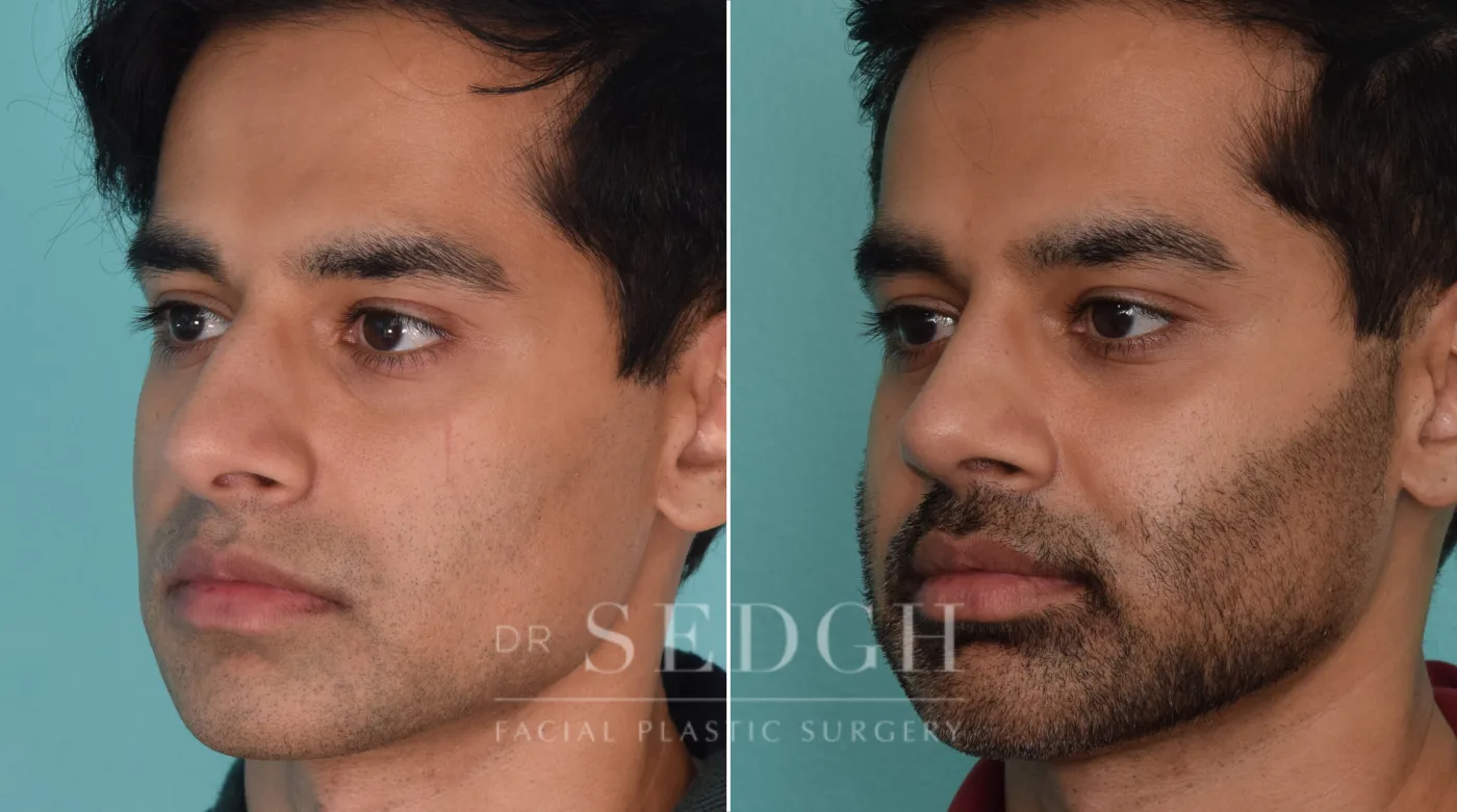 Patient 210 before Middle Eastern Rhinoplasty, view 2
