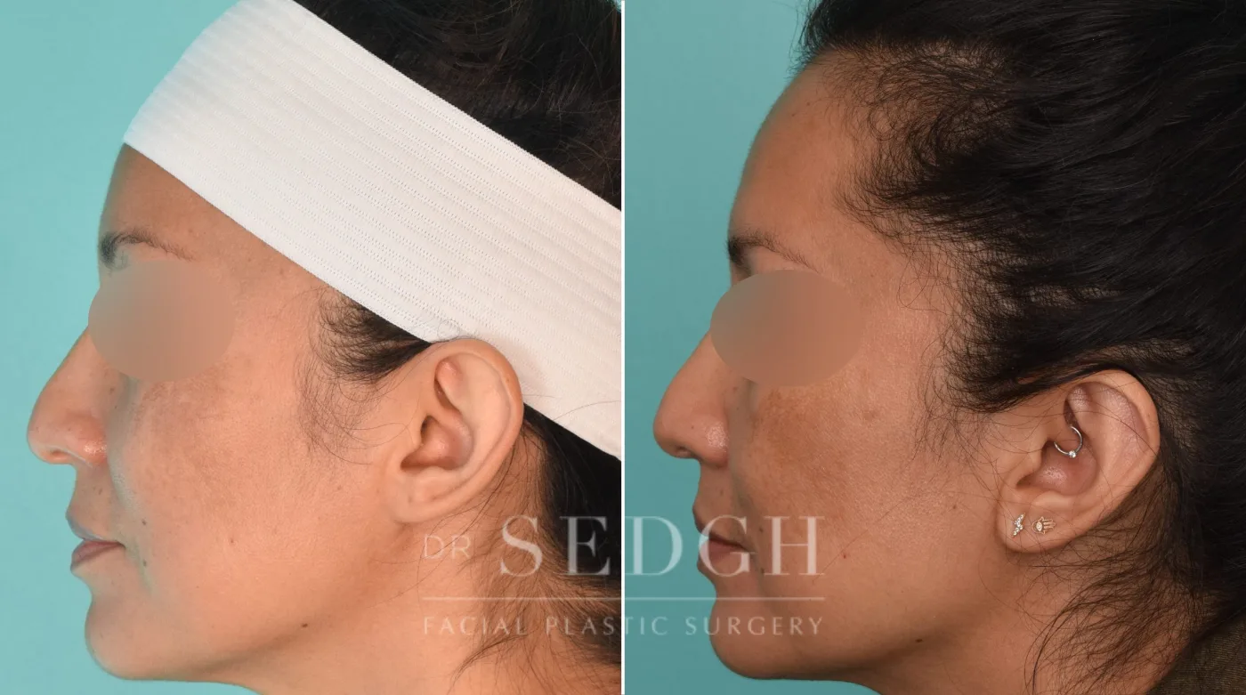 Patient 198 after Ear Pinning Surgery, view 1