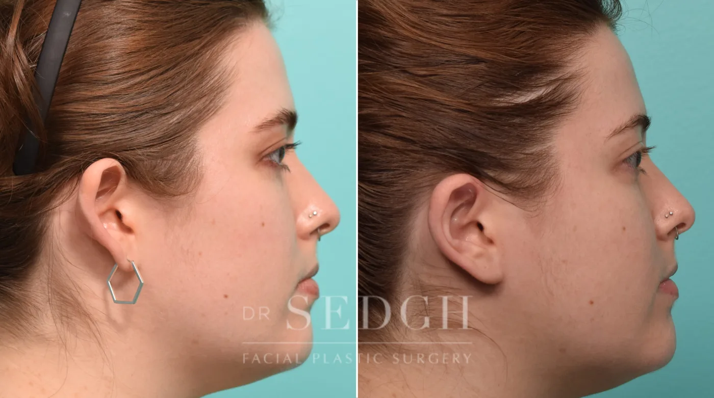Patient 269 after Ear Pinning Surgery, view 2