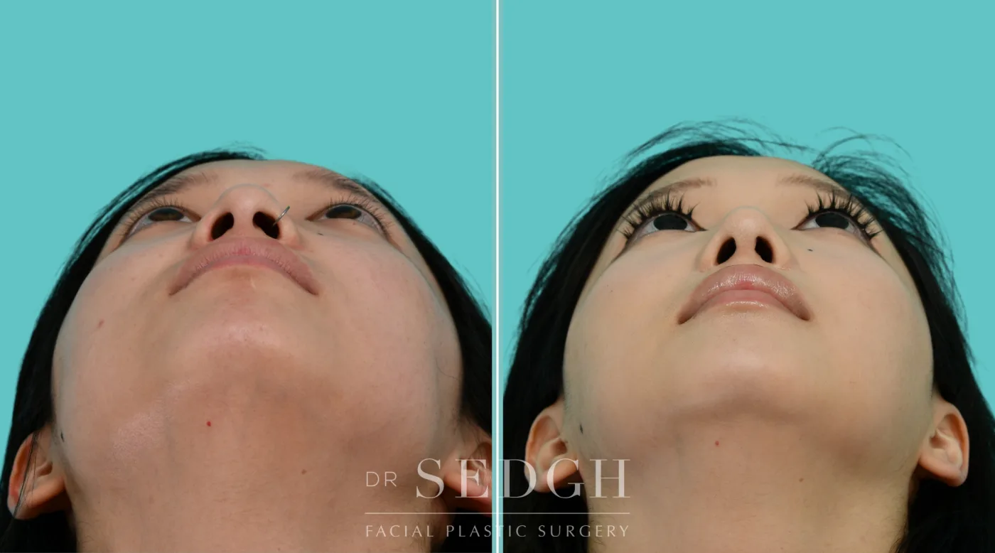 Patient 353 after Asian Rhinoplasty, view 4