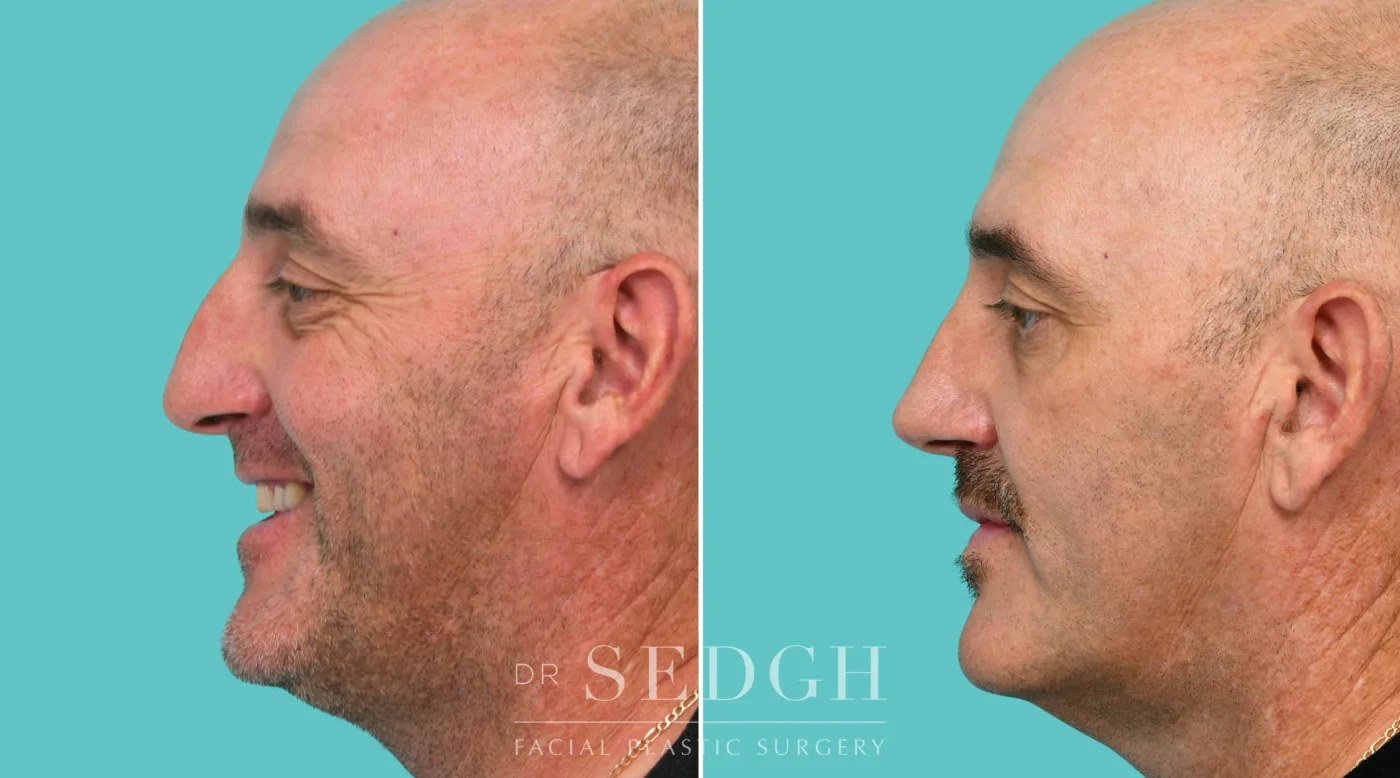 Patient 343 after Crooked Nose Surgery, view 4