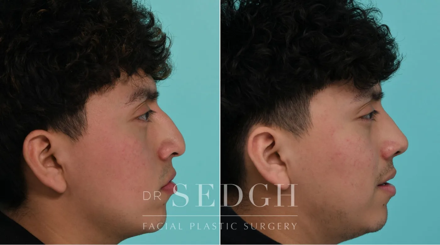 Patient 339 before Male Rhinoplasty, view 1