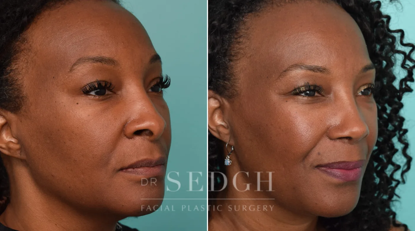 Patient 246 before African American Rhinoplasty, view 2