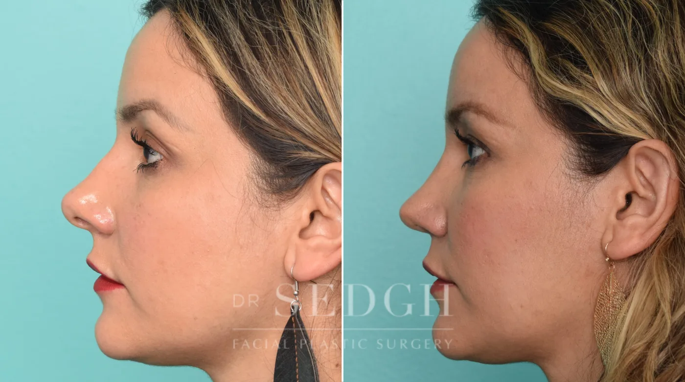 Patient 260 after Rhinoplasty, view 1