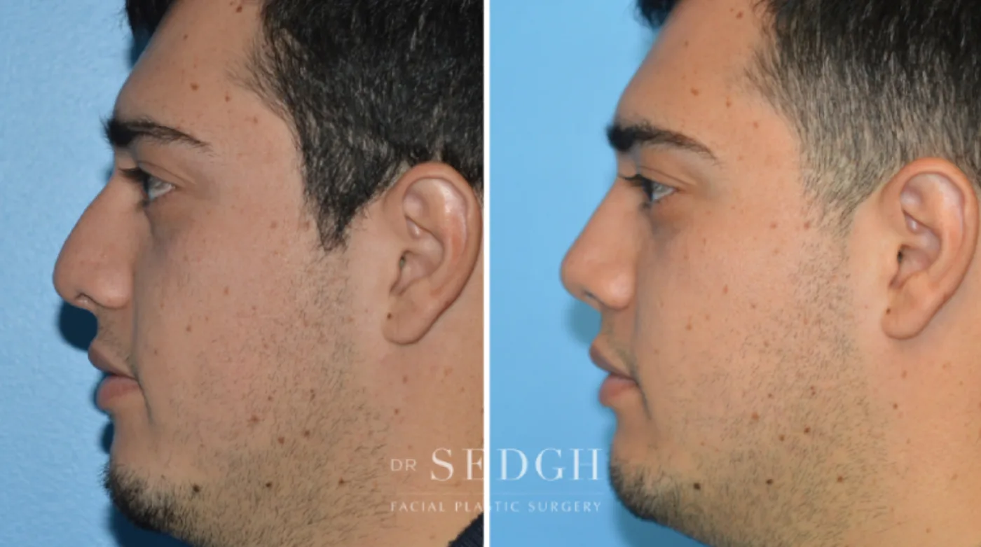 Patient 7 after Crooked Nose Surgery, view 1