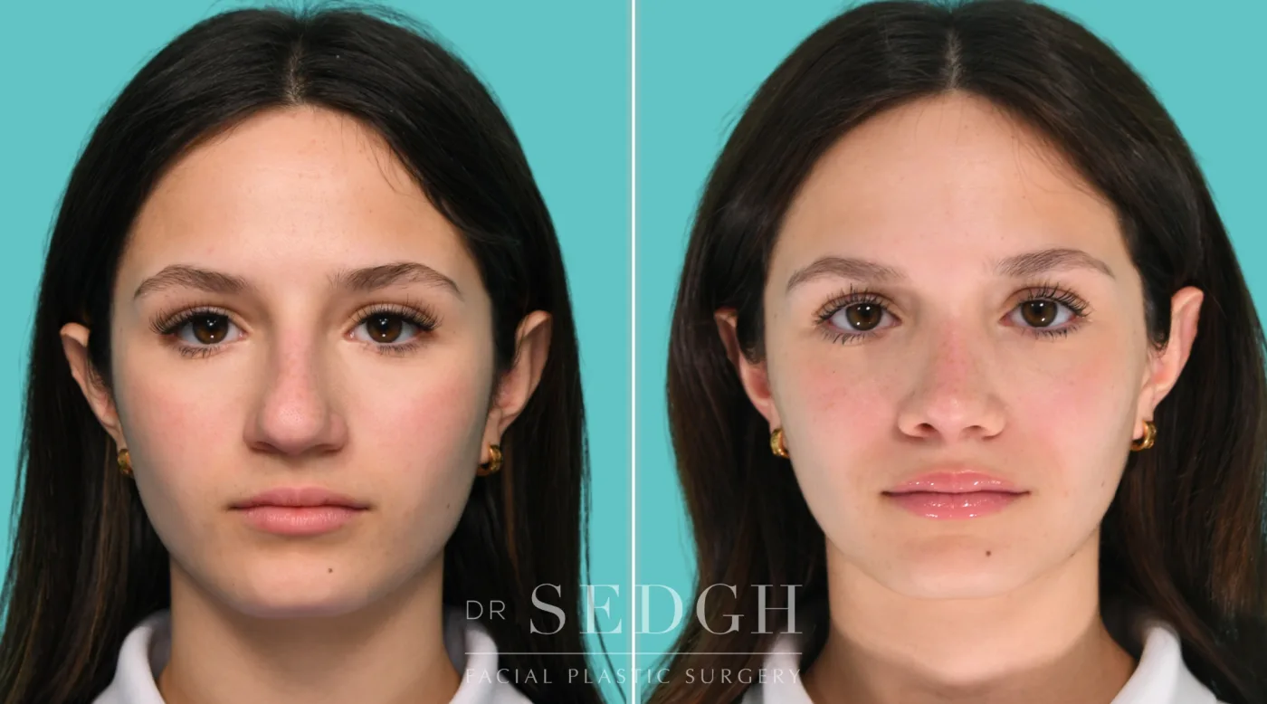 Patient 350 before Middle Eastern Rhinoplasty, view 1