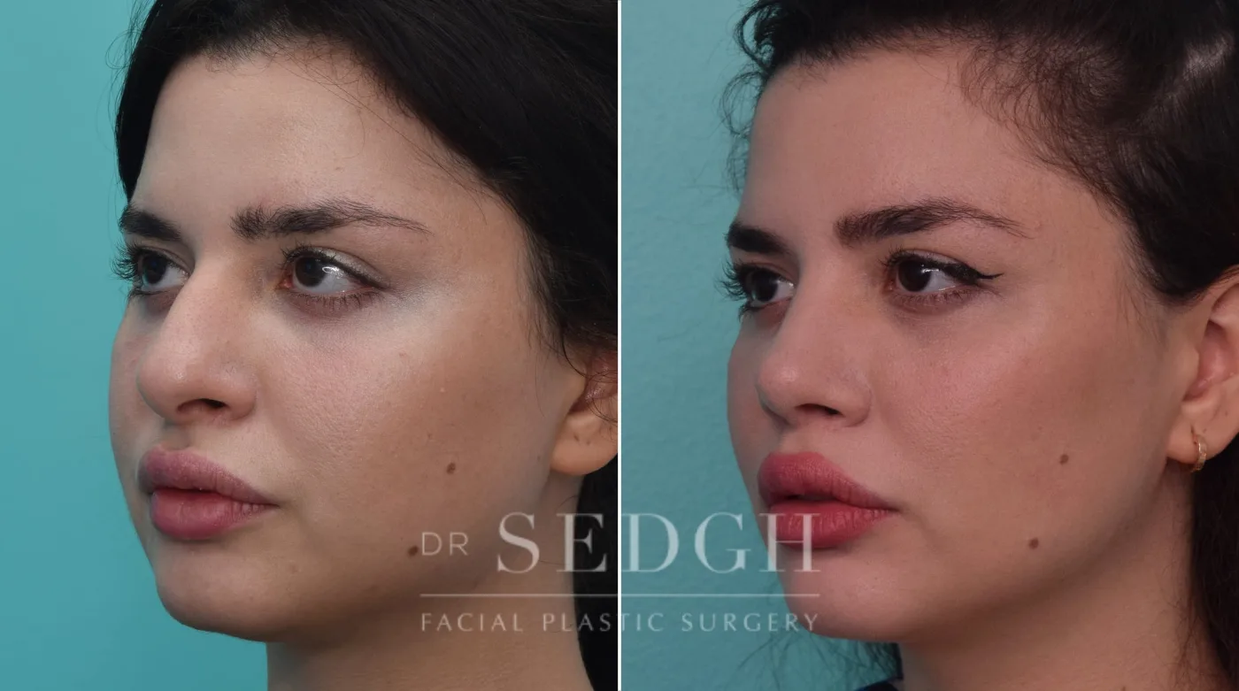 Patient 195 before Rhinoplasty, view 1