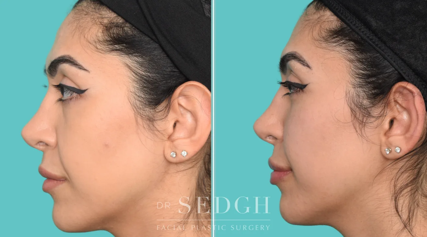 Patient 362 after Flat Helix Repair / Helical Reduction Otoplasty, view 2