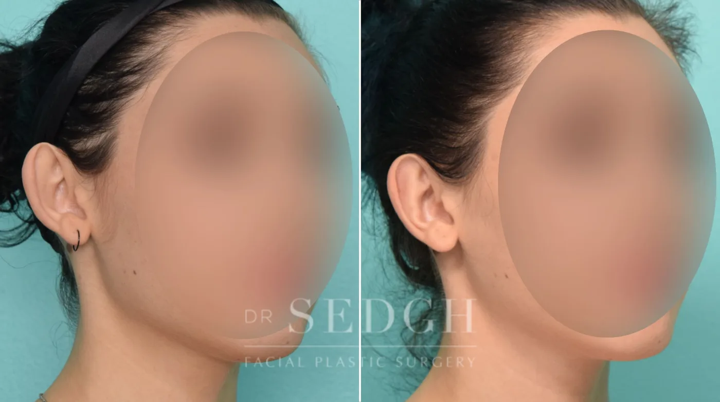 Patient 267 before Ear Pinning Surgery, view 2
