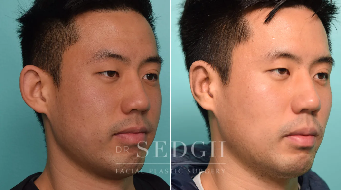 Patient 265 before Ear Pinning Surgery, view 2