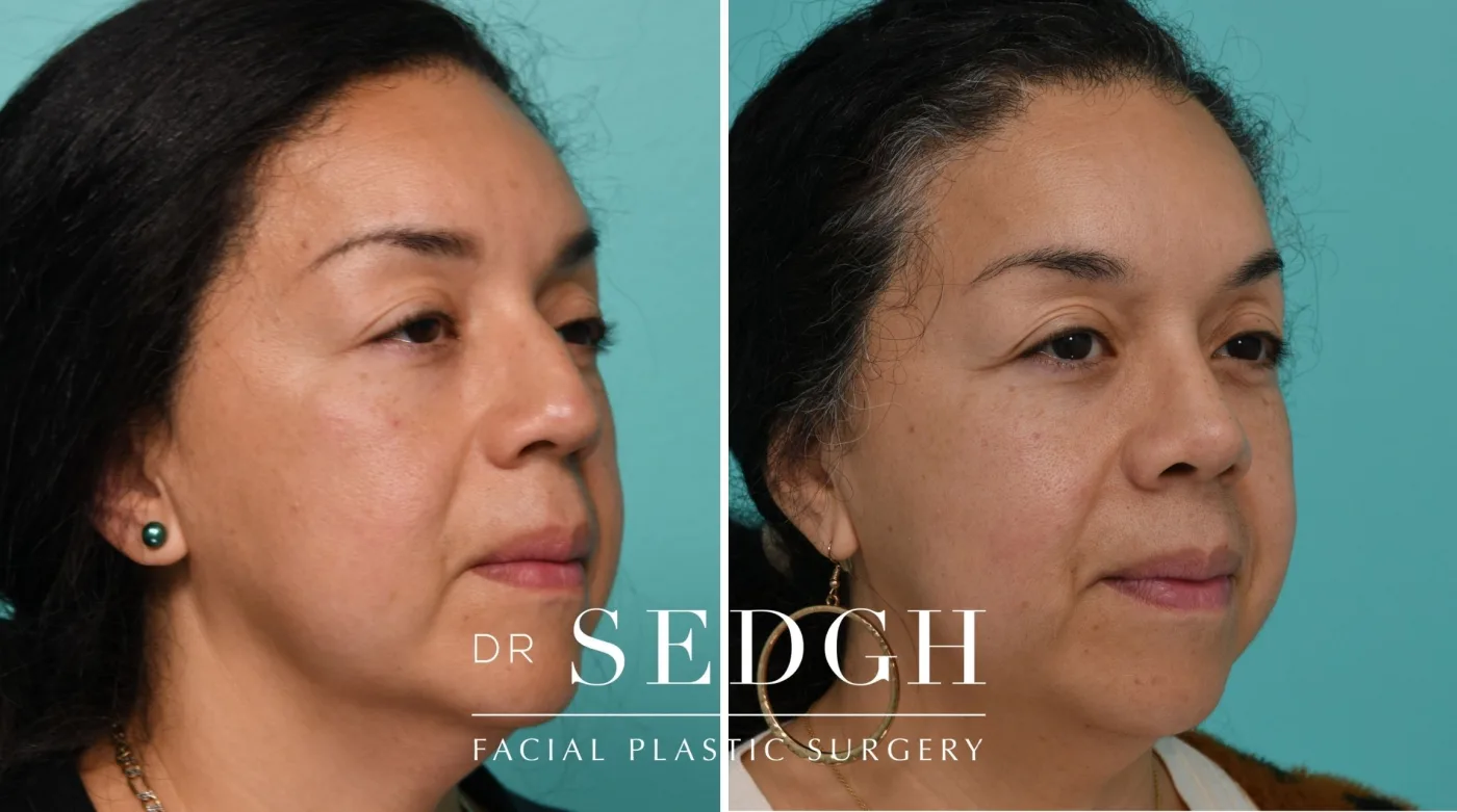 Patient 334 before Female Rhinoplasty, view 2