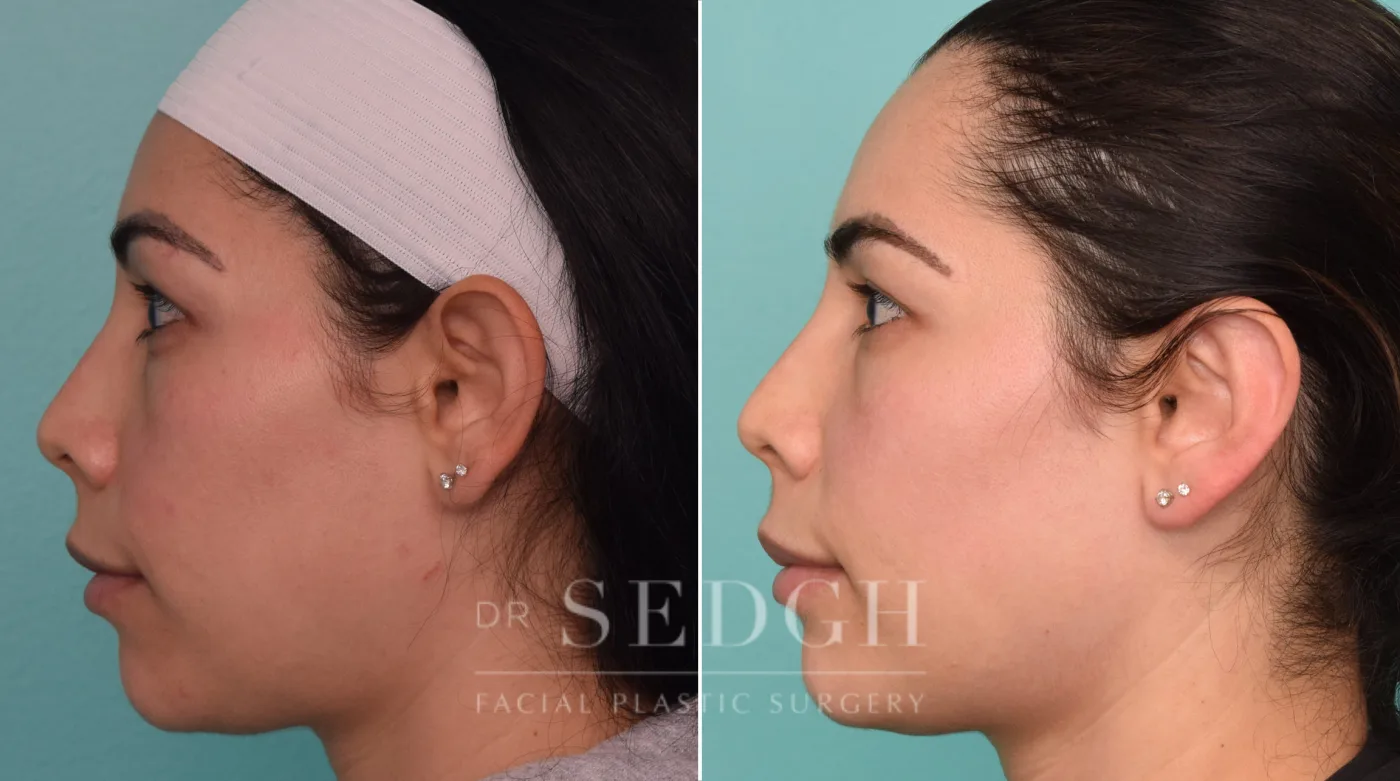 Patient 258 after Ear Pinning Surgery, view 1