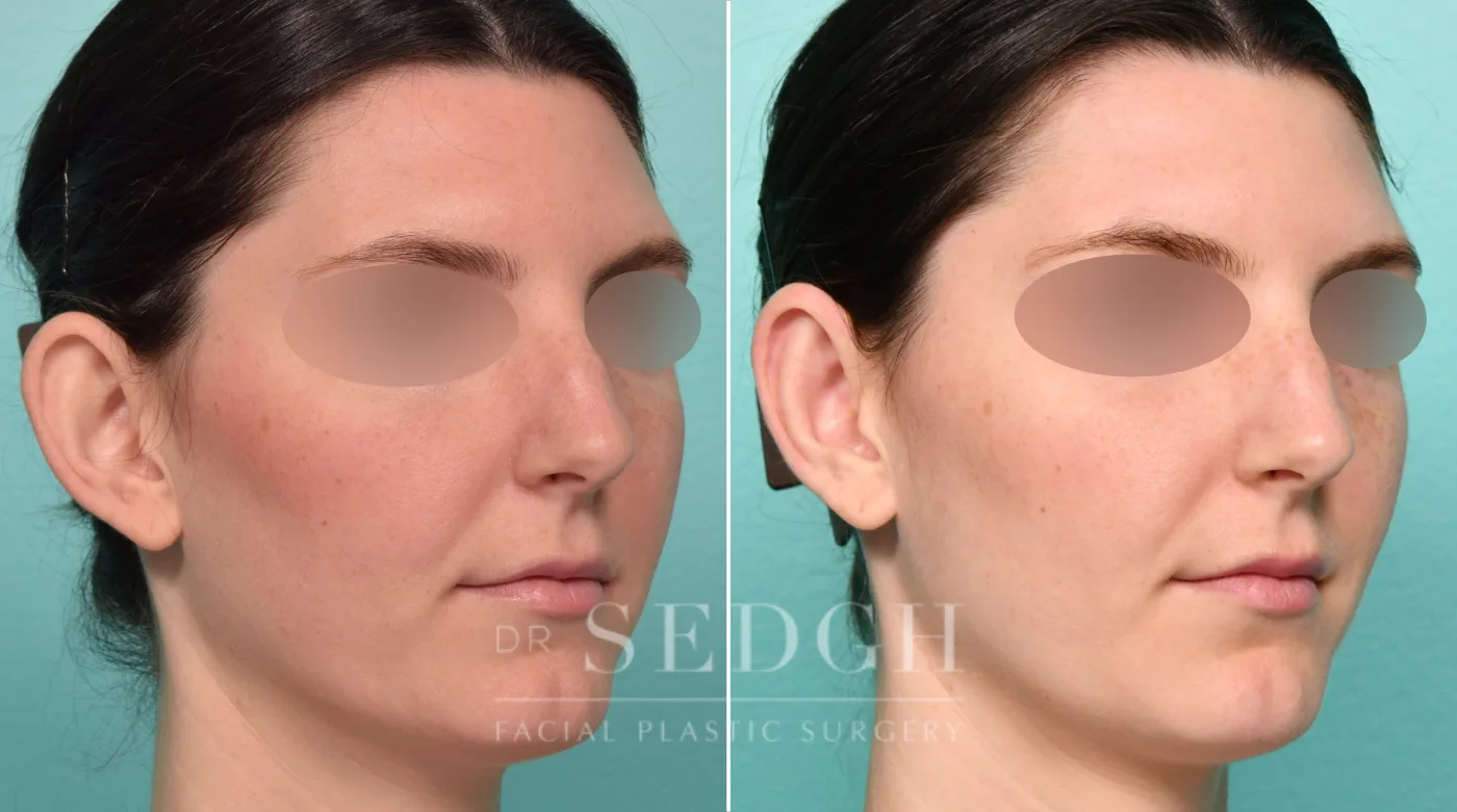 Patient 313 before Ear Pinning Surgery, view 2