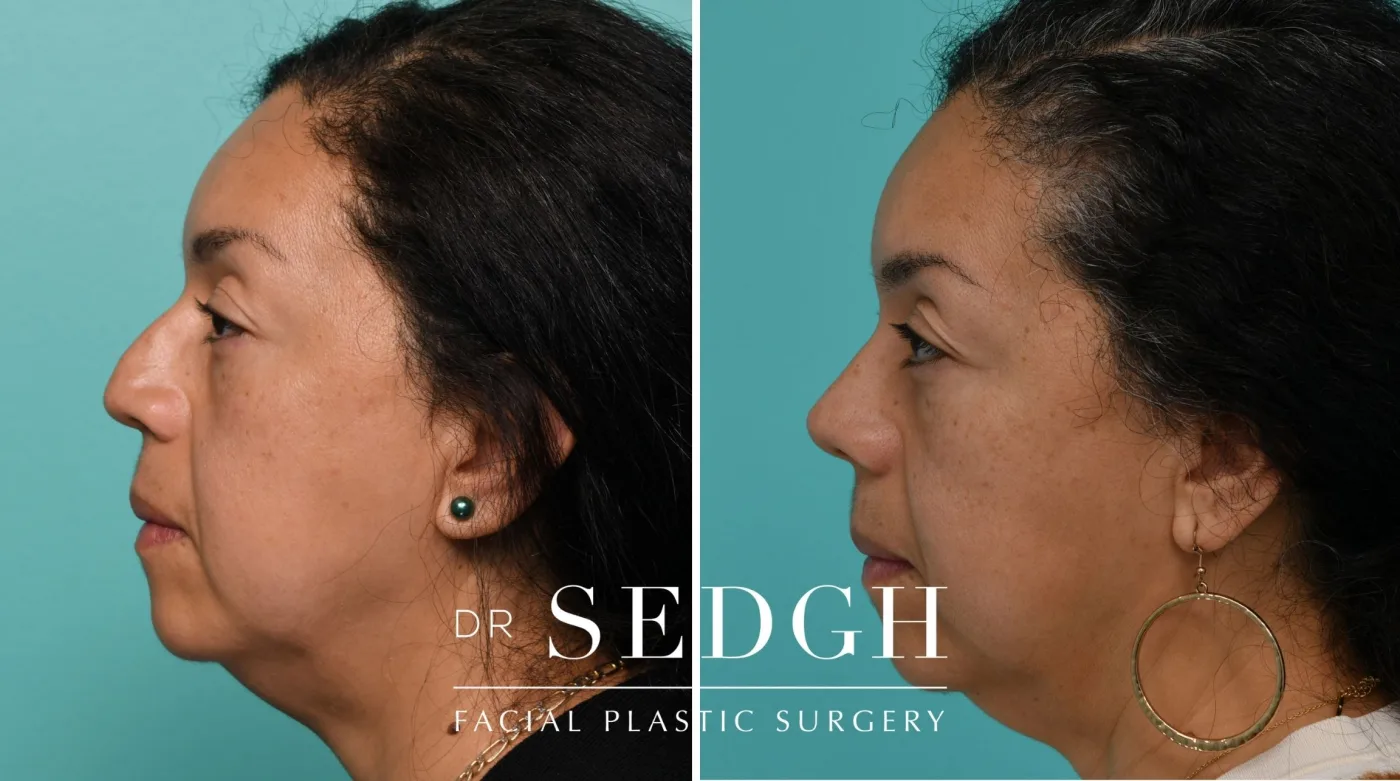 Patient 334 after Female Rhinoplasty, view 1