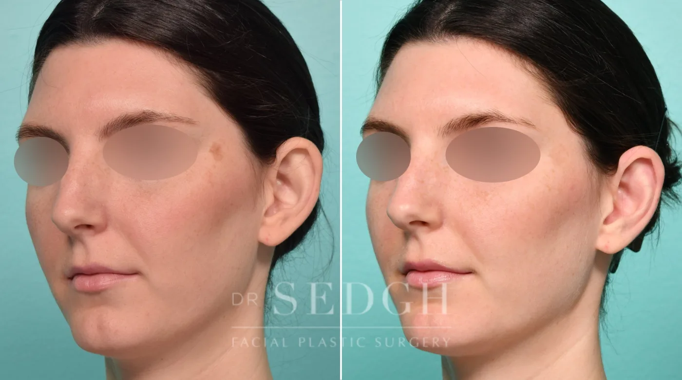 Patient 313 before Ear Pinning Surgery, view 1